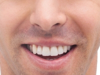 Alveolite secca